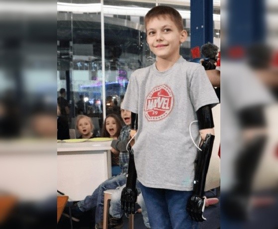 В Башкирии 10-летний мальчик, оставшийся без рук после удара током, получил протезы
