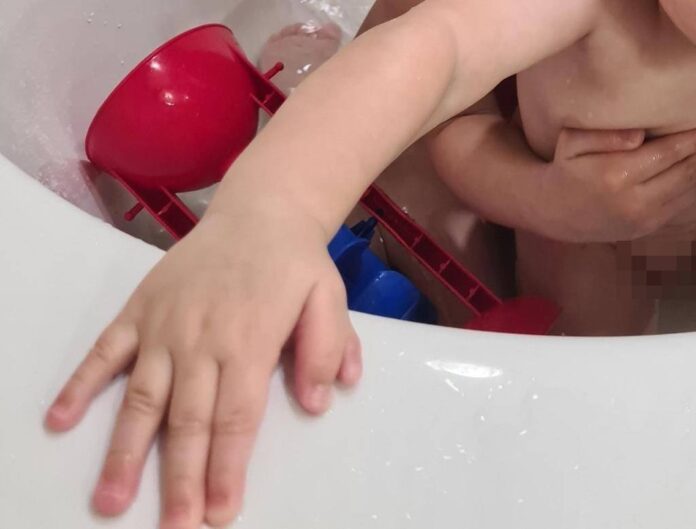 В Башкирии врачи прооперировали 10-месячного ребенка с шестью пальцами