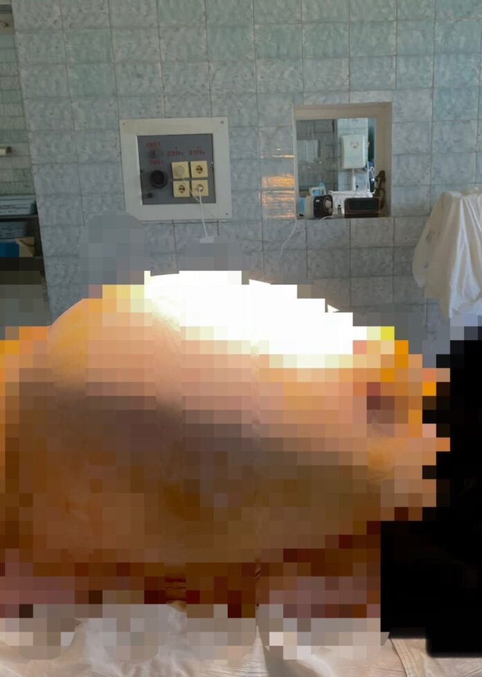 В Башкирии у пациентки удалили гигантскую опухоль малого таза