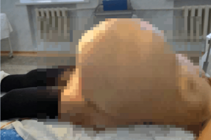В Башкирии прооперировали 62-летнюю женщину с опухолью в 30 литров