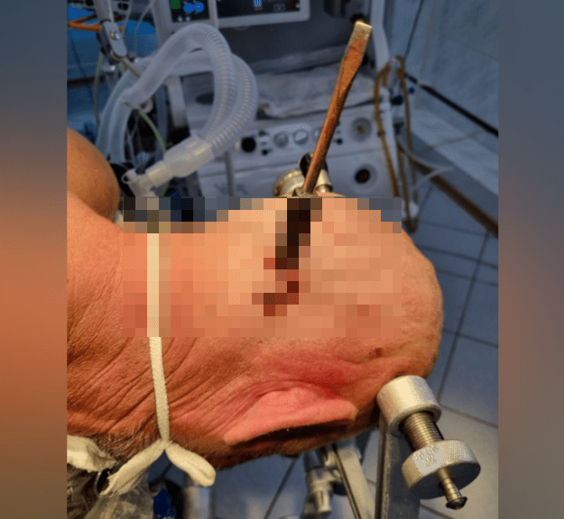 В Башкирии прооперировали мужчину с отверткой в голове